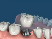 種牙之後係咪可以減少缺牙嘅危害？深圳邊度種牙好？