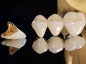 深圳1500元和2500元的全瓷牙套有咩區別？價格貴的使用時間就長嗎？