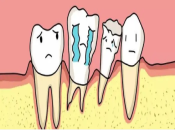 深圳牙周治療——牙齒鬆動和移位是怎麼一回事呢？