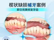 點解補牙要挖一個大洞？維港口腔補牙邊個醫生好？