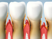 藥物性牙齦增生怎么治疗