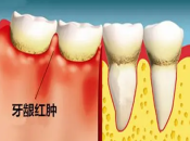 牙齒點解會鬆動，深圳牙科是否可以固定牙齒