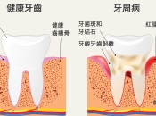 深圳牙周治療幾錢？有牙周病點解要盡快治療？