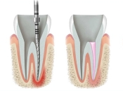 深圳杜牙根後牙齒恢復過程係點樣嘅咧？維港口腔杜牙根收費標準