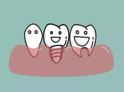 深圳種植牙哪幾部分組成？ 