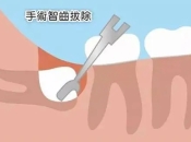 智慧齒唔剝會唔會出事？深圳牙醫叫我剝智慧齒
