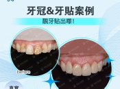 維港口腔牙貼片可以維持幾耐？效果點樣？有冇案例睇睇？