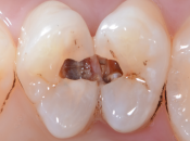 深圳牙醫話我有好多蛀牙，並且可能係遺傳，蛀牙會遺傳？