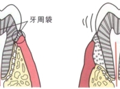 牙周病竟然會誘發多種疾病！深圳牙周專科介紹收費！