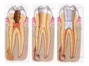 牙根尖發炎與牙髓發炎有什麽區別？