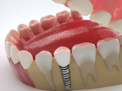 植牙後點解牙醫強調要定期洗牙？深圳植牙幾錢？