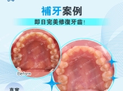 深圳補牙前點解要墊底咧？維港口腔補牙幾錢？