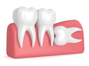 深圳剝智慧齒邊間好？脫智慧齒有冇風險？