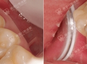 杜牙根後用嵌體好抑或瓷牙套？維港口腔杜牙根幾錢？