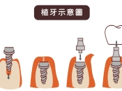 深圳植牙戴上瓷牙套後有咩需要注意嘅咧？深圳植牙幾錢？