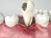 點解牙槽骨骨量會唔夠導致唔可以直接植牙咧？深圳植牙植骨要幾錢？