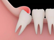 深圳掹牙價錢？智齒發炎容易導致間隙感染？