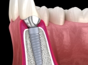 牙周病患者可以植牙嗎？維港口腔植牙點樣？