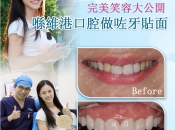 做完牙貼片點解咬唔到嘢？維港口腔牙貼片效果點樣？