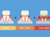 維港口腔牙醫解答：牙周病到底係咩？牙周病治療方式詳解！