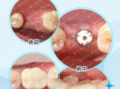 假牙用幾多年就要換咧？維港口腔整全口假牙幾錢？ 