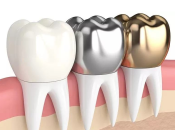 深圳根管治療後牙齒的壽命