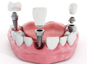 多颗种牙过程注意事项|种好多隻牙點算？深圳好牙科推介！