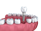 缺牙時間長導致嚴重牙齒問題，喺深圳植牙前要點樣處理咧？