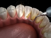 深圳洗牙推薦？邊間牙科係醫生專業洗牙？