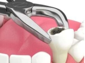 多生牙需要拔掉嗎？深圳拔牙幾錢？