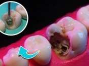 牙齒唔痛點解都要杜牙根咧？深圳杜牙根幾錢？