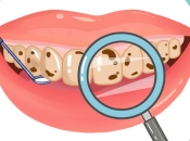 深圳牙齒美白-點解牙齒越嚟越黃？洗牙會洗白牙齒咩？