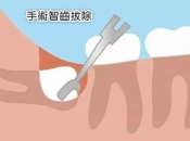 剝智慧齒有冇最佳年紀？深圳牙醫話我宜家剝最好，係真定假？