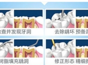 深圳牙科門牙修復，門牙缺損可以用樹脂補牙咩？