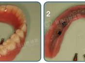 維港口腔半口植牙有優惠？可拆式種植牙係咩咧？