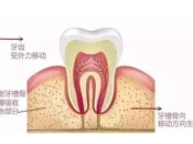 返大陸種牙，點解種牙前醫生要檢查牙槽骨情況？