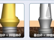 法國安卓健種植體有咩型號咧？附深圳植牙價錢2023
