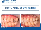 牙齒爛到剩牙腳一定要剝牙？維港口腔杜牙根+打牙樁係咩？殘根去留全解析！