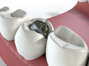 牙齒敏感點處理？大陸蛀牙補牙收費標準2024
