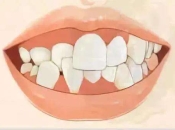 牙齒排列不齊需要矯治嗎