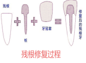 深圳牙科推介，杜牙根點解要打樁咧？ 深圳杜牙根價錢？