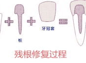 深圳牙科推介，杜牙根點解要打樁咧？ 深圳杜牙根價錢？