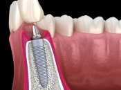 大陸植牙嘅瓷牙套有問題可以換嗎？維港口腔植牙最新優惠