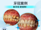 【深圳牙科推薦】固定假牙碎咗點處理？維港口腔專業牙醫教你解決方法