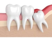 拔智齒後會變蠢嗎？羅湖拔智齒價錢？