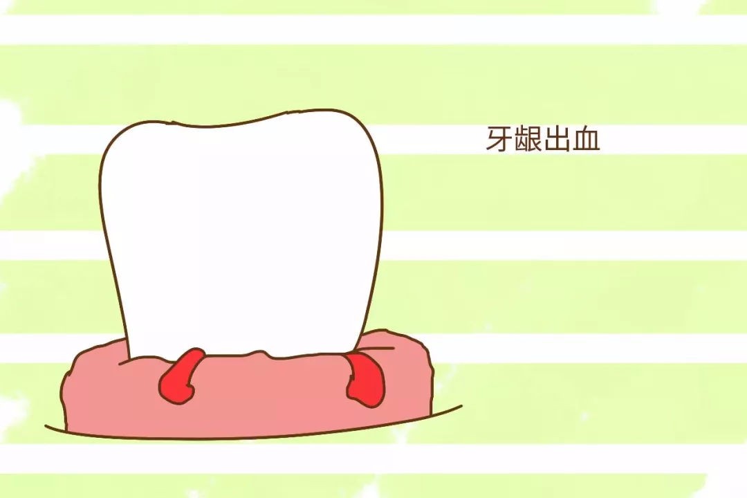 牙齦出血應該怎麽防治？