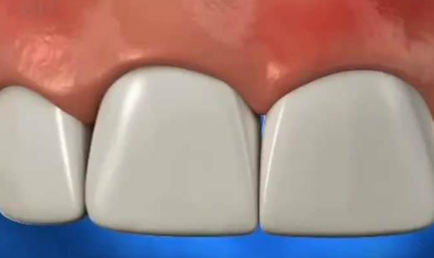 深圳牙周治療-長期服用某些藥物會引起牙齦增生嗎？