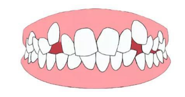 深圳箍牙-牙齒咬合異常會導致頭痛耳鳴？