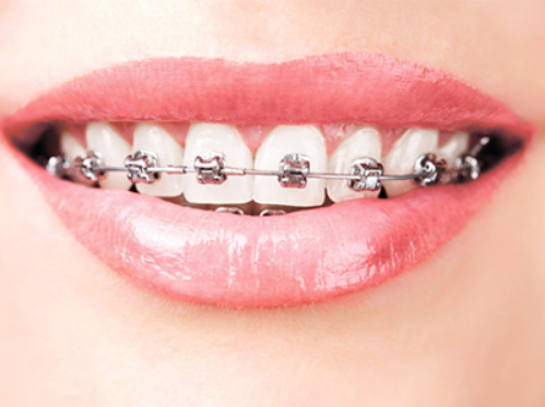 深圳箍牙-正畸治療中的口腔護理是怎樣的呢？