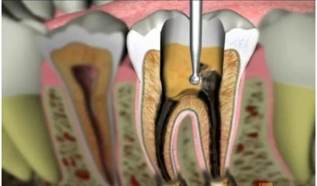 牙髓病是什麽？會有哪些症狀呢？